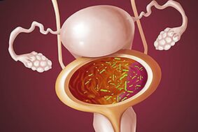 Bakteriális cystitis egy nőben