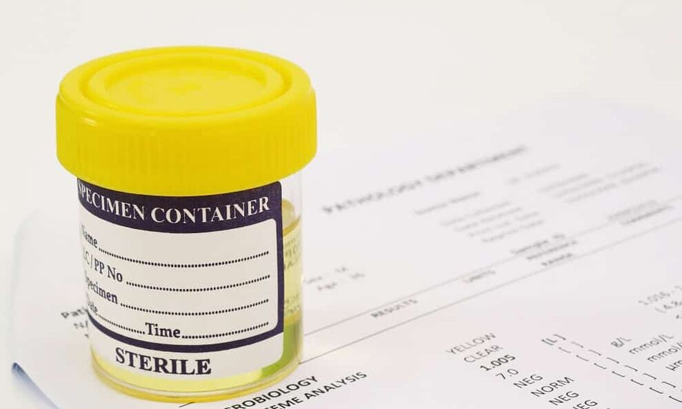 Az antibiotikumok szedése előtt vizeletvizsgálatot kell végezni