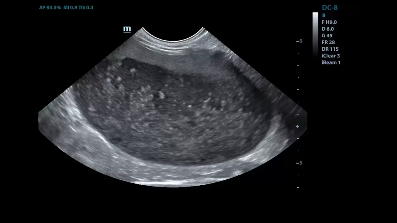 cystitis az ultrahang képeimben a Cystolax használata előtt